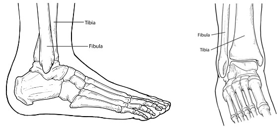 Capital foot and ankle care - Patient education - Ankle fractures