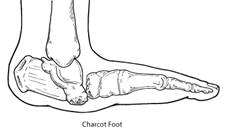 Charcot