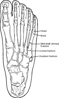 5th Metatarsal