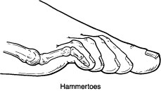 Hammertoe1