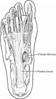 Fibroma