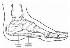 Fibroma2