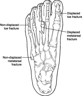 Toe Fracture